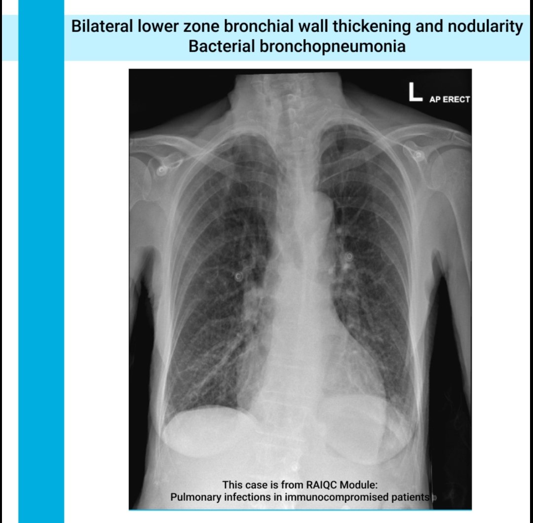 Bronchopneumonia! 

What did you think?

Keep tuned for our next case!

#radres #radreg #radiology #FOAMed #medicine