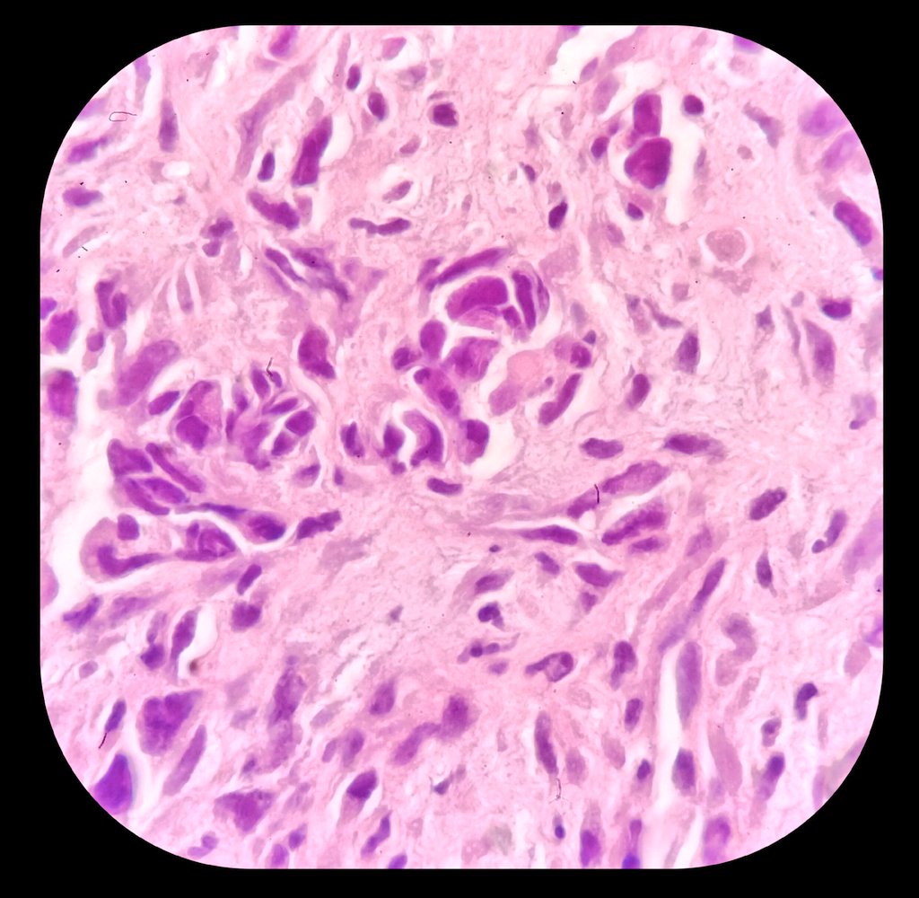 ♂️ in his 80s.
🩺 Hemothorax ➕ pleural nodules.
💉 Pleural biopsy.
🔬 Angiosarcoma.  IHC ➕ ERG, FLI1, D240, CD31.

3️⃣ #PINA2024 ➕ Reunión del grupo de trabajo de Patología Intervencionista de la <a href="/SEAP_IAP/">SEAP-IAP</a>.
🗓️ 27/04/24.  Salón de actos del <a href="/HUCA_Asturias/">@HUCA</a>.