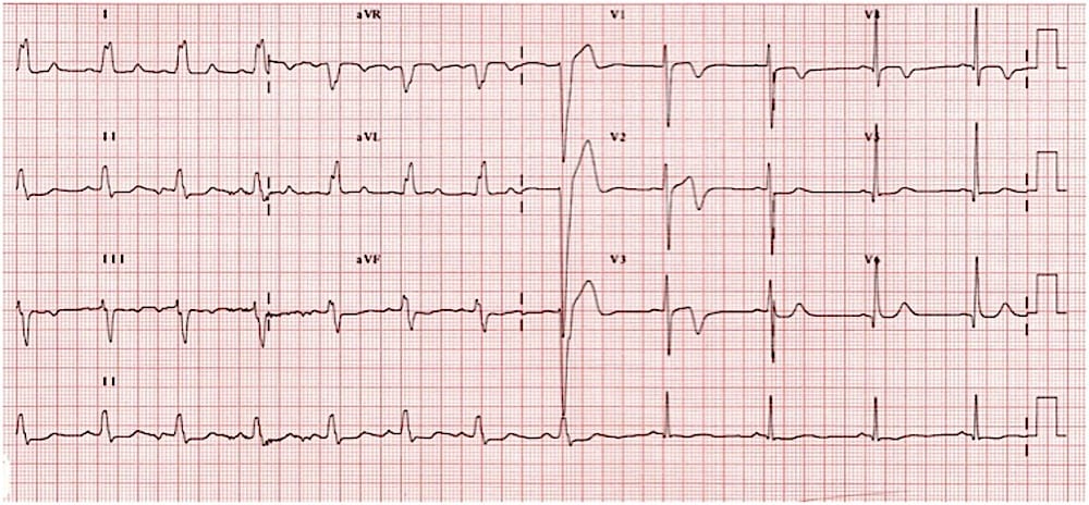 Is it possible to be pain-free and in VT? Our latest ECG Exigency case explores the peculiar ECG of a patient awaiting a bed for chest pain investigation. Check it out! litfl.com/pain-free-and-… #MedEd #MedTwitter #CardioTwitter #FOAMed
