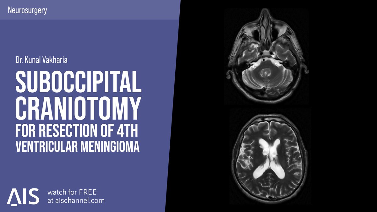 🚨 New #OpenClassroom alert! Dr. @KunalVakhariaMD 🇺🇸 from @USFNeurosurgery delves into Suboccipital Craniotomy for 4th Ventricular Meningioma. A must-watch for understanding advanced #Neurosurgery techniques & patient-focused care 👉 aischannel.com/society/retrop… #IamAIS #some4surgery