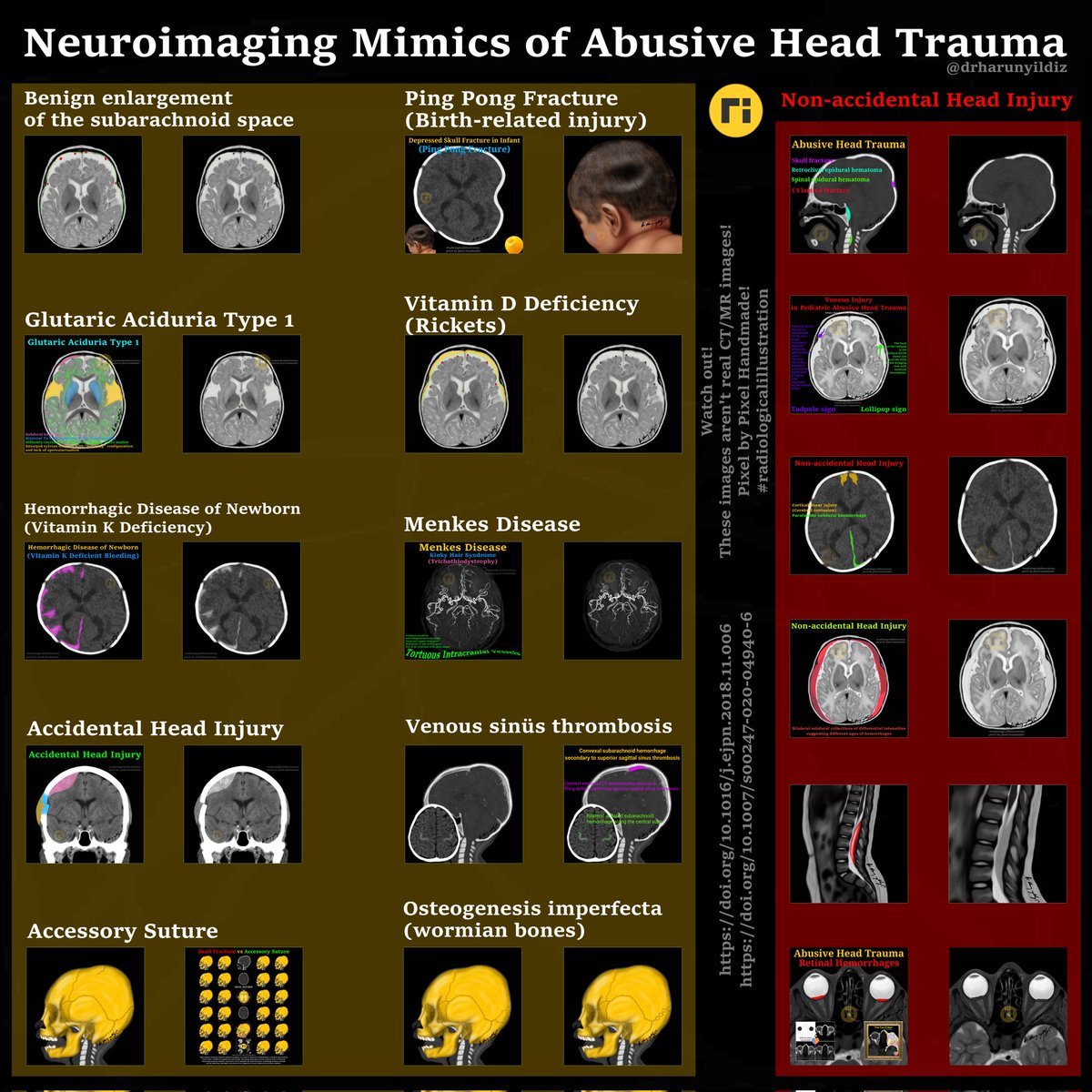 Neuroimaging Mimics of Abusive Head Trauma doi.org/10.1016/j.ejpn… doi.org/10.1007/s00247… #radiologicalillustration ✍️ pixel by pixel handmade!