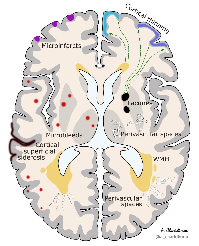 ⭕️Small Vessel Disease (cSVD) ~ 🧠MRI markers  

~Nothing small about cSVD!

#NeuroTwitter #NeuroRad #Neurology #Neurosurgery #stroke #MedStudentTwitter #FOAMncc #MedTwitter #amyloidangiopathy #FOAMncc #neuroscience #brain #Alzheimers #Alzheimer #illustration #neuropath #cSVD