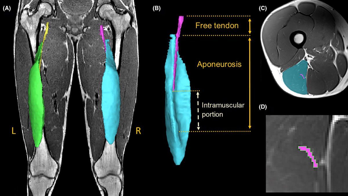 Available now, Open Access: Biceps femoris long head muscle and aponeurosis geometry in males with and without a history of hamstring strain injury We show differences in BFlh aponeurosis volumes in previously injured versus uninjured males. onlinelibrary.wiley.com/doi/full/10.11…