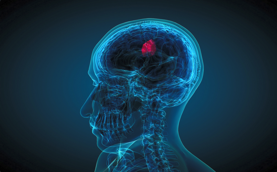DrRobClemens's tweet photo. Dexmedetomidine Prevents Chronic Incisional Pain After Brain Tumor Resection
https://t.co/QlK7w9S9f4
#anesthesiology #anesthesia #prevention #chronic #incisional #pain #brain #tumor #braintumor #resection #surgery https://t.co/PfzOXt5c9j
