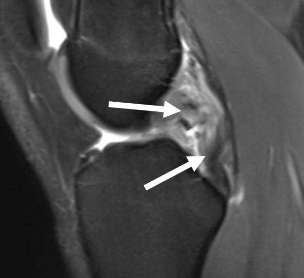 Rehabbing from #PCL surgery? Our protocol emphasizes early motion, brace use & gradual return to weight-bearing activities. This approach has resulted in faster recovery, reduced knee stiffness, and better functional outcomes for our patients. medilink.us/k4v8 #KneeRehab