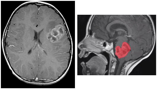 Alonso_Lab's tweet photo. #pHGG, including #DMG, are aggressive brain tumors and the leading death cause in pediatric population. Despite tireless efforts over the years, the prognosis remains grim with a median overall survival time of 8-14 months, influenced by tumor location and Histone-3 status (2/15) https://t.co/7kSbVnUTQ2