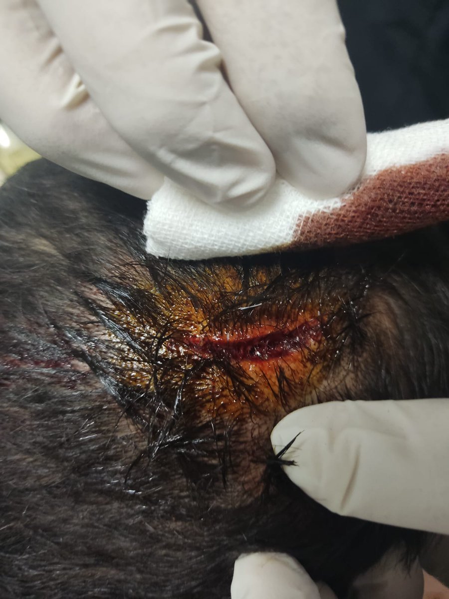 hemsireyizbiz_'s tweet photo. Tekirdağ Çorlu'da Protez ve Ortez Teknikeri arkadaşımıza hastanenin bir yöneticisi tarafından saldırı yapılmış. Bardakla kafasını yaralamış öldürmeye teşebbüs edilmiştir.

Şiddeti hâlâ çözüme kavusturmayanlardan sizce bakan yada yönetici olur mu? #sağlıktaşiddet https://t.co/5mEx1qZwNA