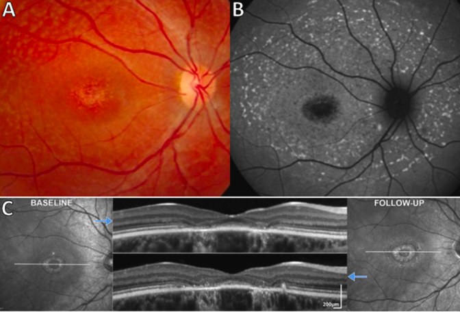 PRER article from @MichelMichaelid and collaborators who provide expert insight into genetics and imaging of photoreceptor degeneration #RetinaAwarenessMonth #retina #RP @MoorfieldsBRC @UCLeye @Wills_Eye featureshttps://www.sciencedirect.com/science/article/pii/S1350946224000090