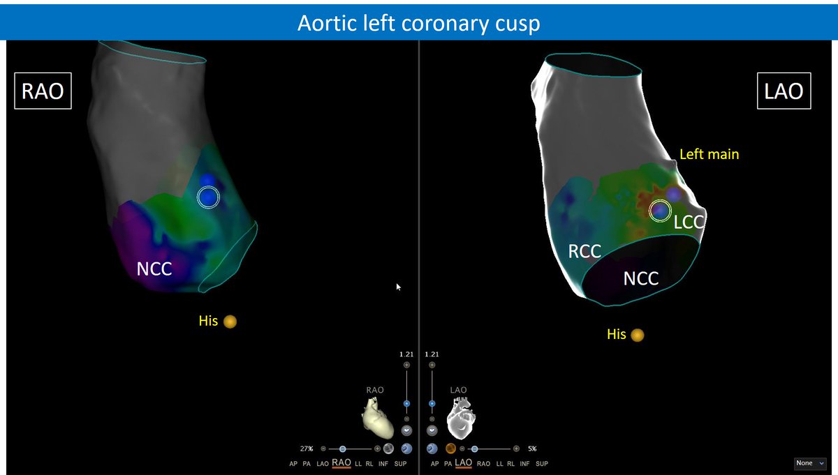 Arritmias_HRC's tweet photo. LV SUMMIT ventricular ectopy ABLATION with Carto v8... transient success from aortic LCC and pulmonary artery. Final success 😃at GCV... with great local signals‼️ 👇🧵. Blue tags show transient and definite success   #Epeeps https://t.co/Q0lAXW4ylG