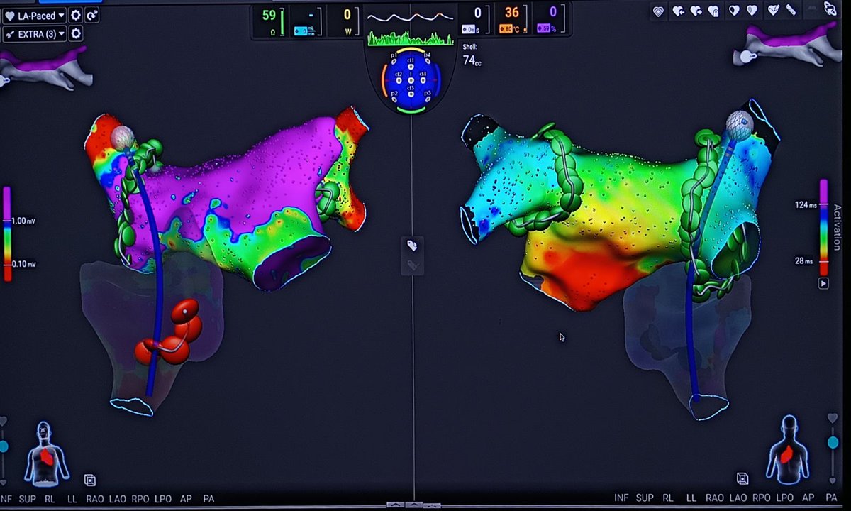 AF/AFL case with Affera system. CTI bidirectional block within 1min (RF time 25 sec). @SteliosDragasis @ipetemil @Kariki_O @athsaplaouras @PetrosSkalidis @MEfraimidis #ePeeps #Medtronic #OCSC