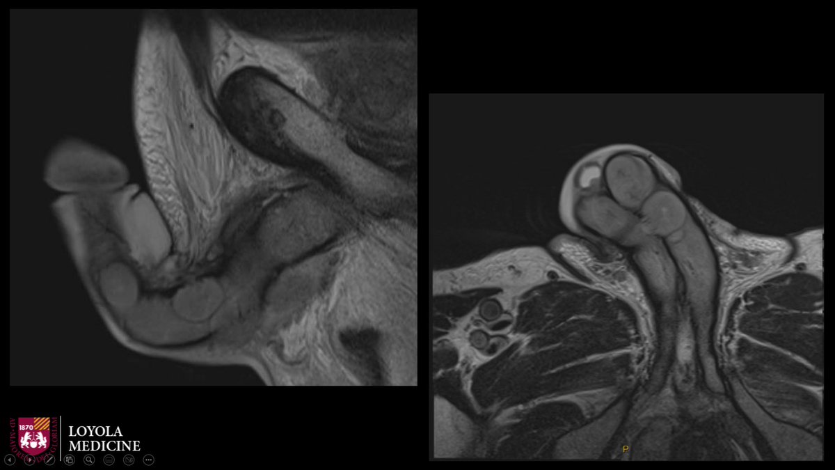 Loyola Urology (@loyolaurology) on Twitter photo Very proud of Dr. Hartman (PGY6) and Dr. Lough (PGY2) for winning 🥇 and 🥈place at <a href="/ChiUroSociety/">ChicagoUrologicalSociety</a> annual Shapiro imaging contest for their presentations on malignant pirapism 🍆and post-renal transplant urinary incontinence 💦 Very proud of Dr. Hartman (PGY6) and Dr. Lough (PGY2) for winning 🥇 and 🥈place at <a href="/ChiUroSociety/">ChicagoUrologicalSociety</a> annual Shapiro imaging contest for their presentations on malignant pirapism 🍆and post-renal transplant urinary incontinence 💦