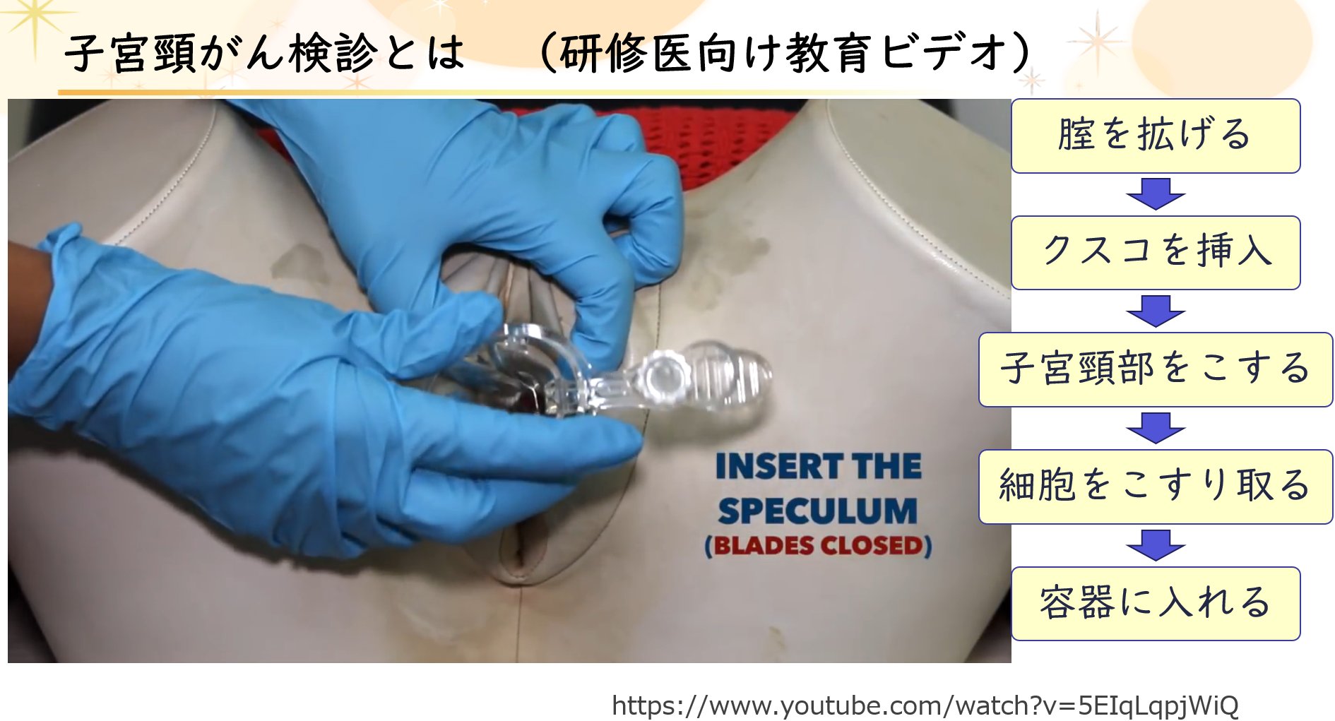 クスコ子宮 