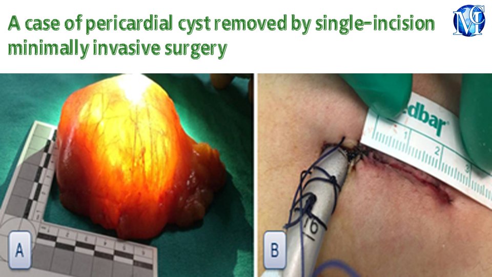 A case of pericardial cyst removed by single-incision minimally invasive #surgery, published in Journal of #Lung, Pulmonary & #Respiratory Research by Mehmet Agar, et al. medcraveonline.com/JLPRR/JLPRR-11… #radiography #ultrasound #cardiology #medicine #heart