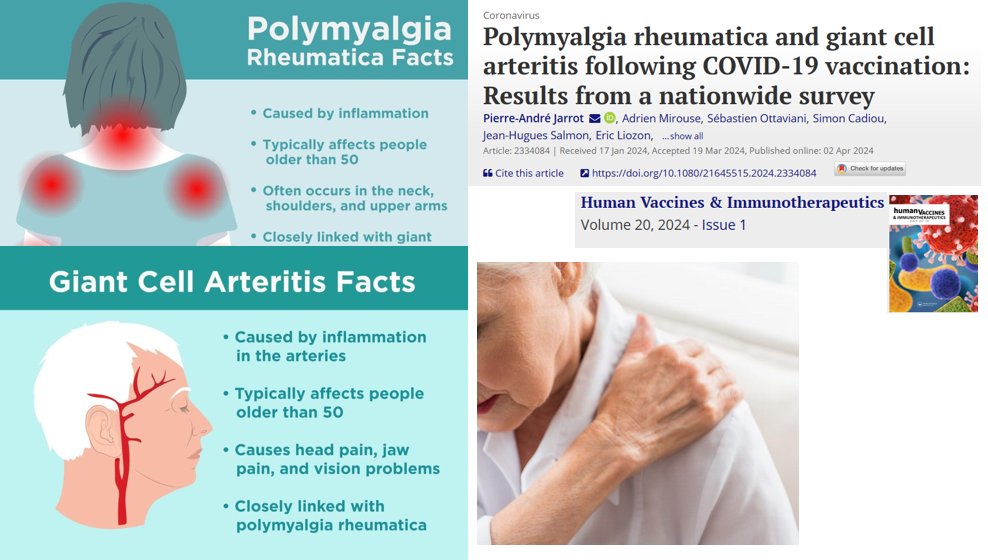 Polymyalgia rheumatica & giant cell arteritis following COVID-19 vaccination: tandfonline.com/doi/full/10.10… 'Physician should be aware of this potential vaccine-related phenomenon.' (!) #covidvaccine #vaccination #vaccine #mRNA #Health