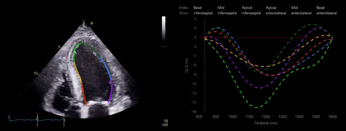 FDA clearance for Us2.v2, featuring 45 automated echo parameters, including strain analysis, marking a significant stride in medical innovation! us2.ai/us2-ai-receive…