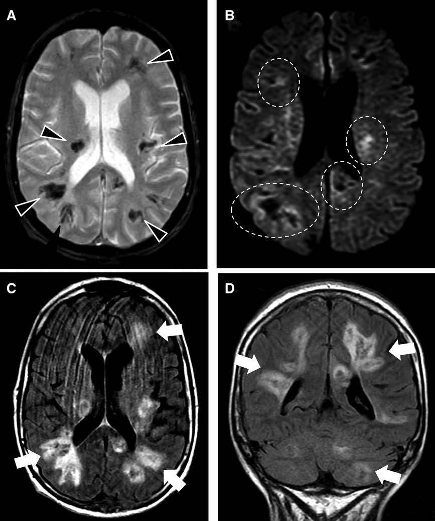 #STROKE #TopicalReview by Tartarin et al.: There are numerous rare, hard-to-diagnose causes of ICH, which the practicing clinician must be aware of to effectively prevent subsequent events. #AHAJournals ahajournals.org/doi/10.1161/ST…
