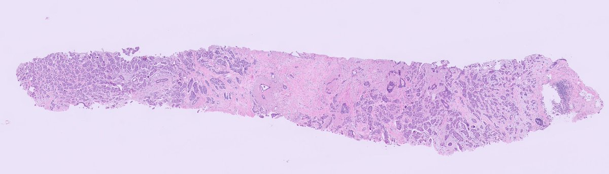 kis_lorand's tweet photo. #breastpath Not every case is difficult to diagnose 👇👇
BIRADS 5 lesion, core needle biopsy...
IHC just for fun😁it is EMA
#pathology #PathTwitter https://t.co/3Ct3dNEkrs