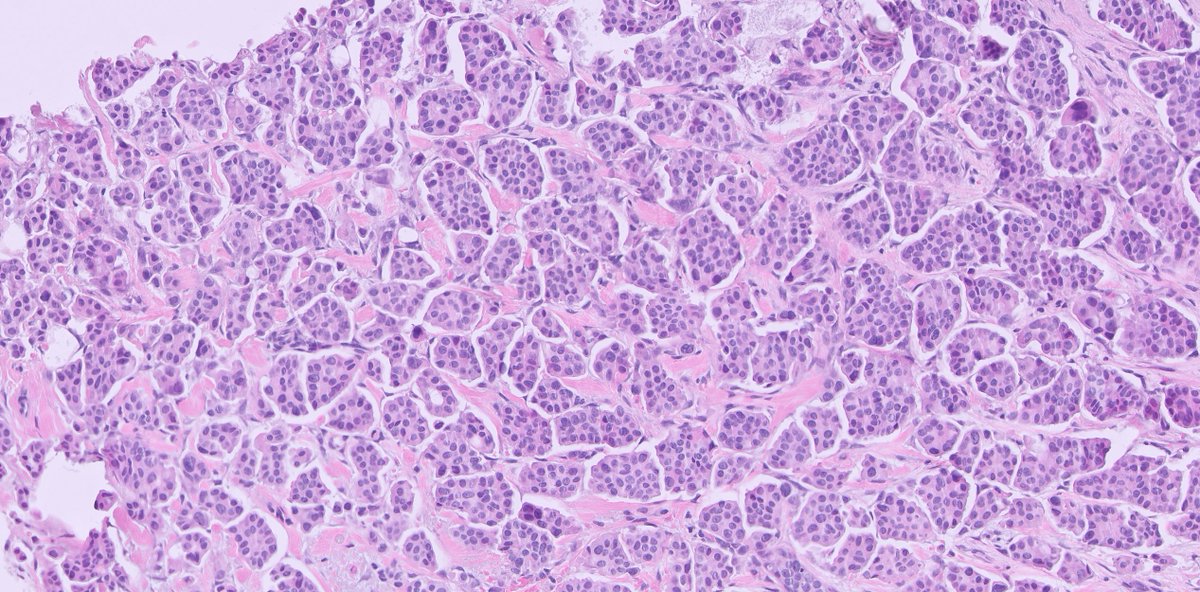 kis_lorand's tweet photo. #breastpath Not every case is difficult to diagnose 👇👇
BIRADS 5 lesion, core needle biopsy...
IHC just for fun😁it is EMA
#pathology #PathTwitter https://t.co/3Ct3dNEkrs