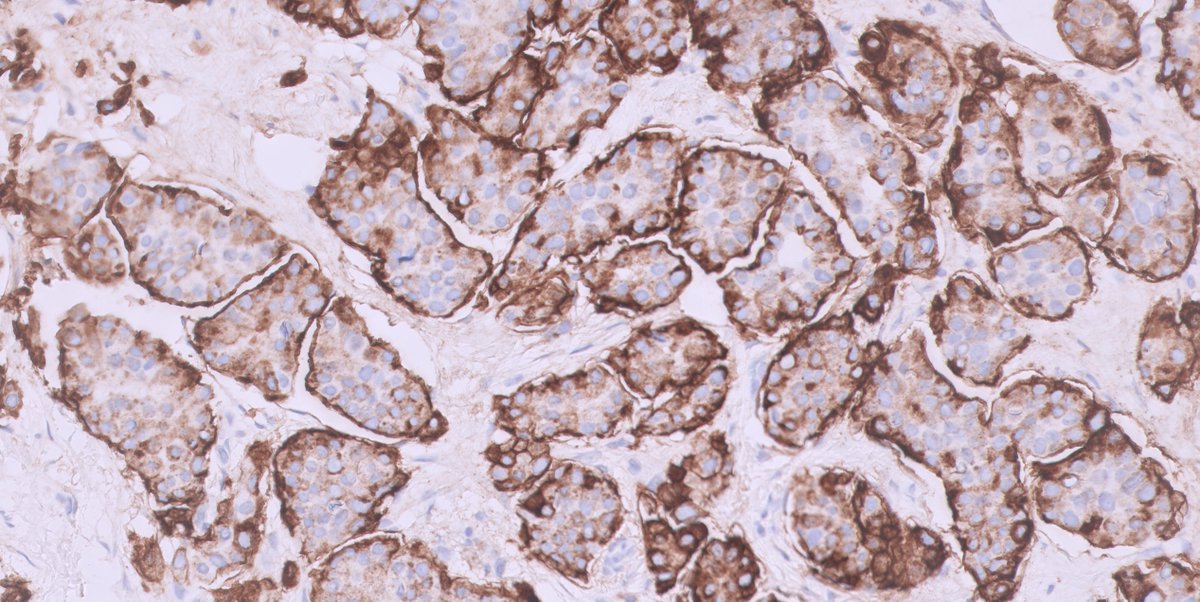 kis_lorand's tweet photo. #breastpath Not every case is difficult to diagnose 👇👇
BIRADS 5 lesion, core needle biopsy...
IHC just for fun😁it is EMA
#pathology #PathTwitter https://t.co/3Ct3dNEkrs
