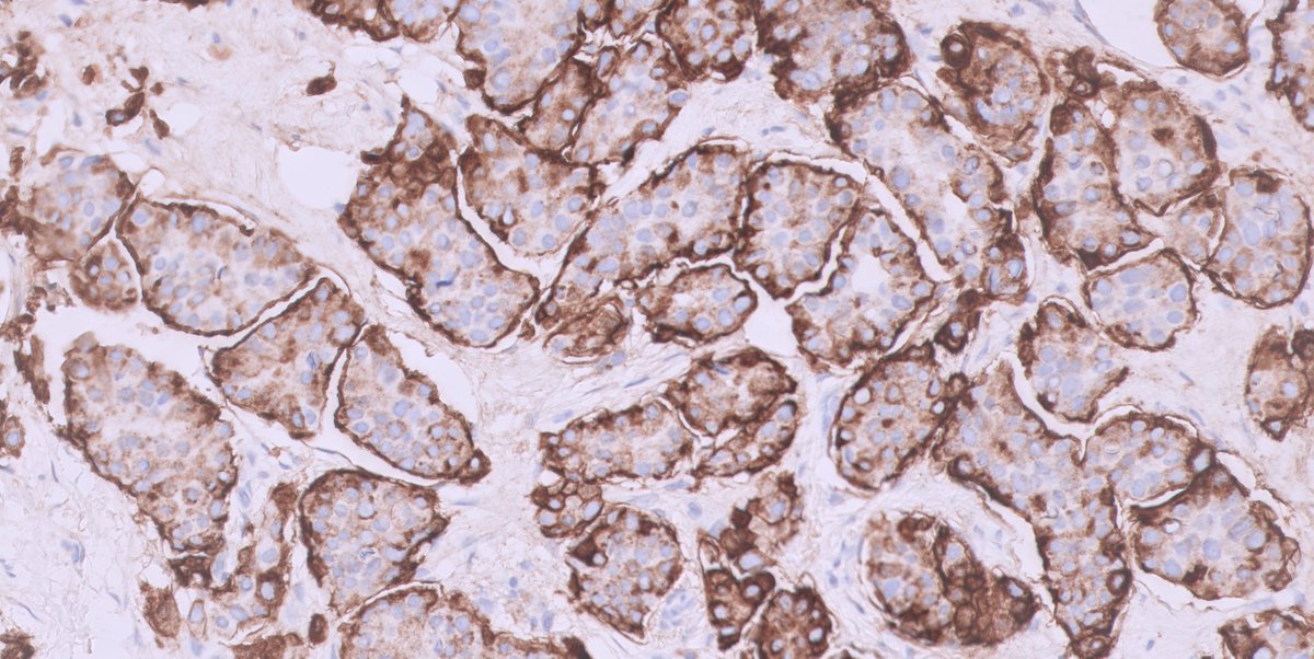 #breastpath Not every case is difficult to diagnose 👇👇
BIRADS 5 lesion, core needle biopsy...
IHC just for fun😁it is EMA
#pathology #PathTwitter