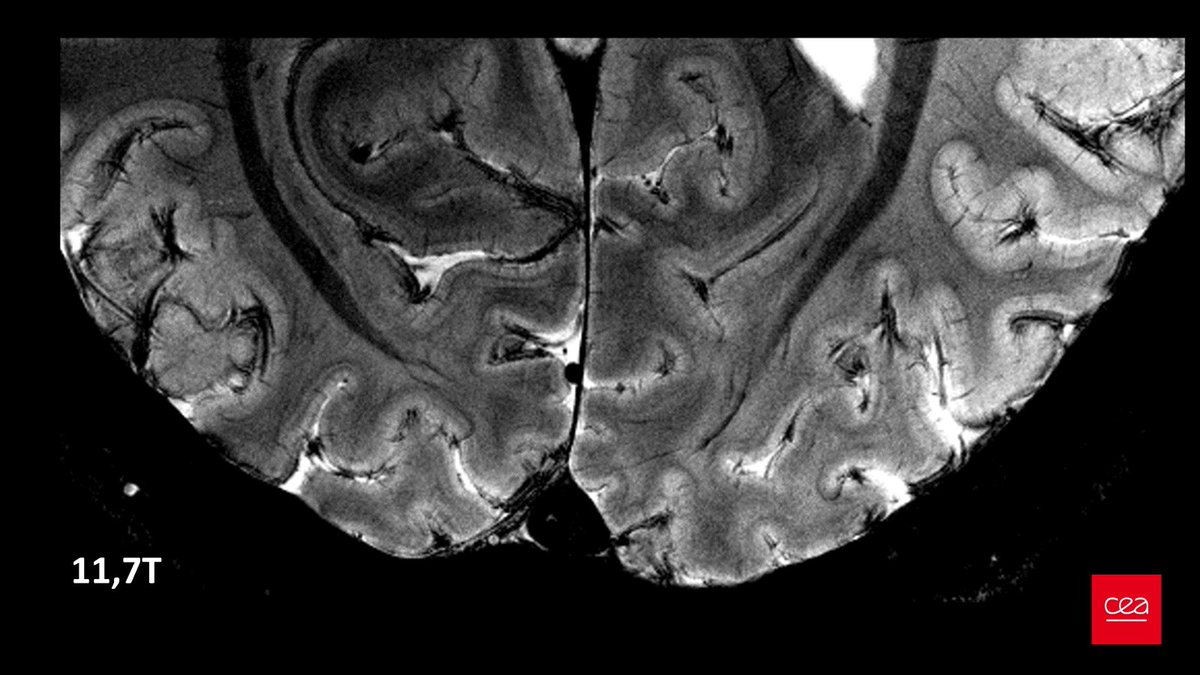 More details beyond the first ever images of the human brain acquired in vivo with our @CEA_Officiel Iseult #MRI #ultrahighfield scanner @NeuroSpin_91  operating at an unprecedented field of 11.7T (223000 times the Earth field!): doi.org/10.21203/rs.3.…