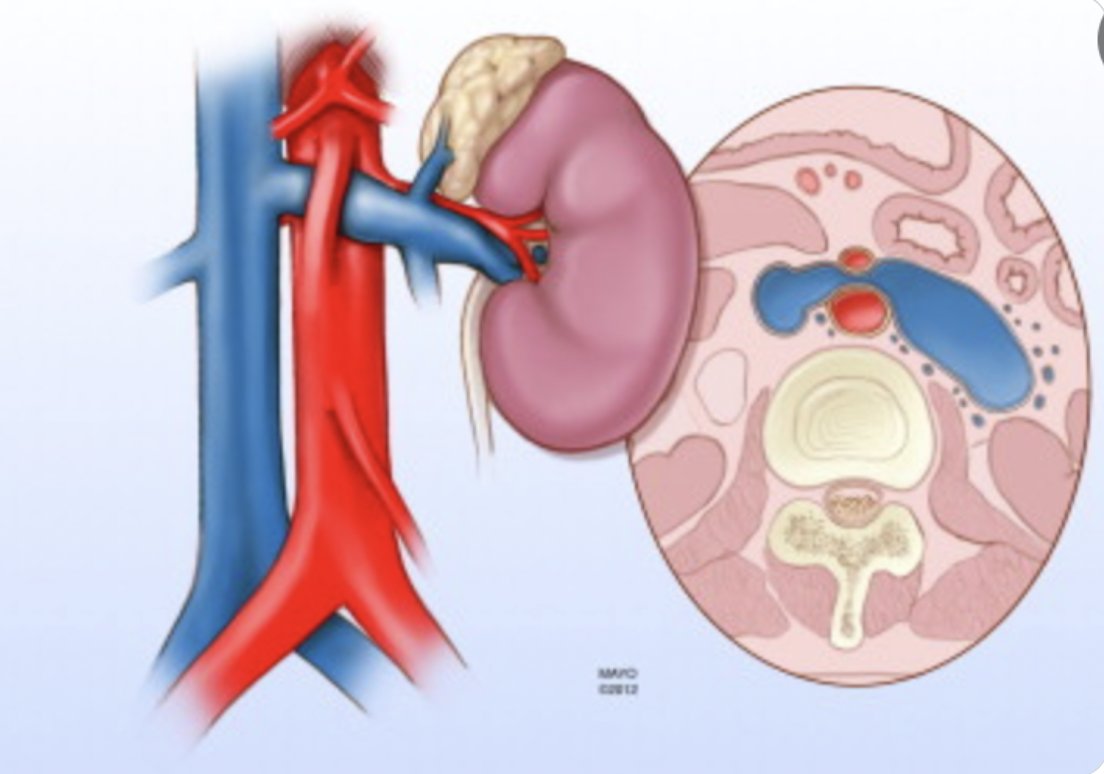 Renal Nutcracker Syndrome! A rare cause of left renal vein thrombosis. Abdominal aorta and superior mesenteric artery compress the left renal vein. Results in: Symptoms ⬆️with activity Hematuria Orthostatic proteinuria Vericocele Left renal vein thrombosis