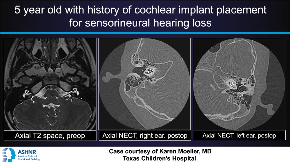 #ASHNRCOTW #247: Child with hearing loss. Thx @pedsneurorad 4 case! #ASHNR24 Answer w/ appropriate GIF only -- stay professional & don't spoil it! @callyrobs @DShatzkes @CDP_Rad @nakoontz @rhwiggins @KRileyMD @CMGlastonbury @cmtomblinson @tabby_kennedy @PhilipRChapman1