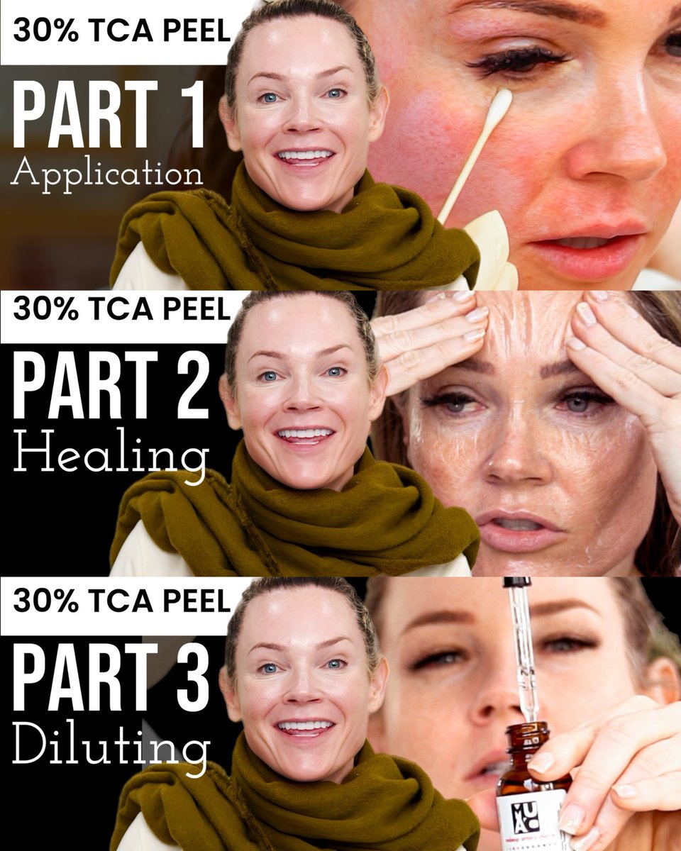 SpaAndTellYT's tweet photo. This is a 3 part series of videos on how to do a 30% TCA PEEL at home. All of them will premiere back to back - April 4th at 5:15 pm PST | 8:15 pm EST 

Part 1: How to use TCA peel at home? https://t.co/QaYYqE5wcI

#30tcapeel #tcapeel #tca #tcapeels #spaandtell https://t.co/DMCidQ4JRP