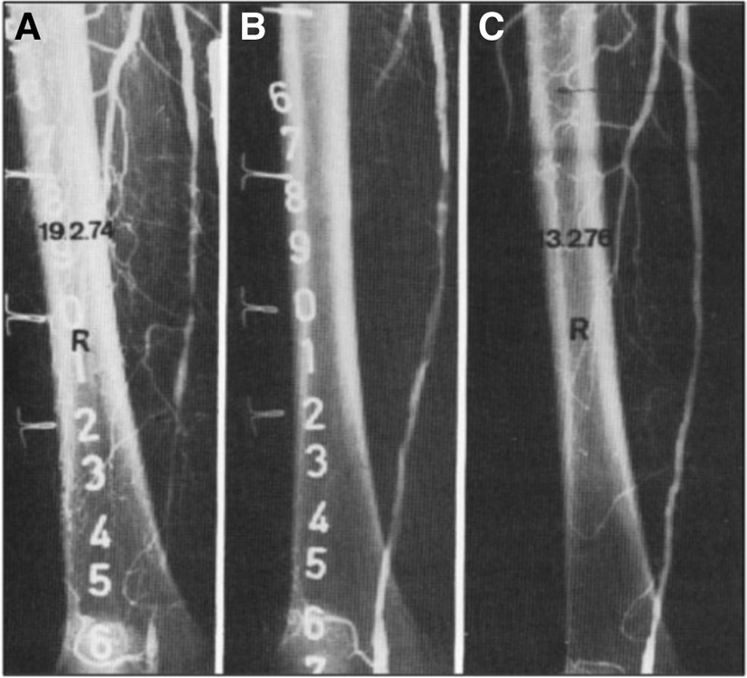 This year marks the 50th anniversary of the first balloon percutaneous transluminal angioplasty (PTA), a landmark event in cardiovascular medicine. Cardiopulse celebrates the event doi.org/10.1093/eurhea… #PTA #angioplasty #stent #PCI #cardiotwitter @ESC_Journals @escardio