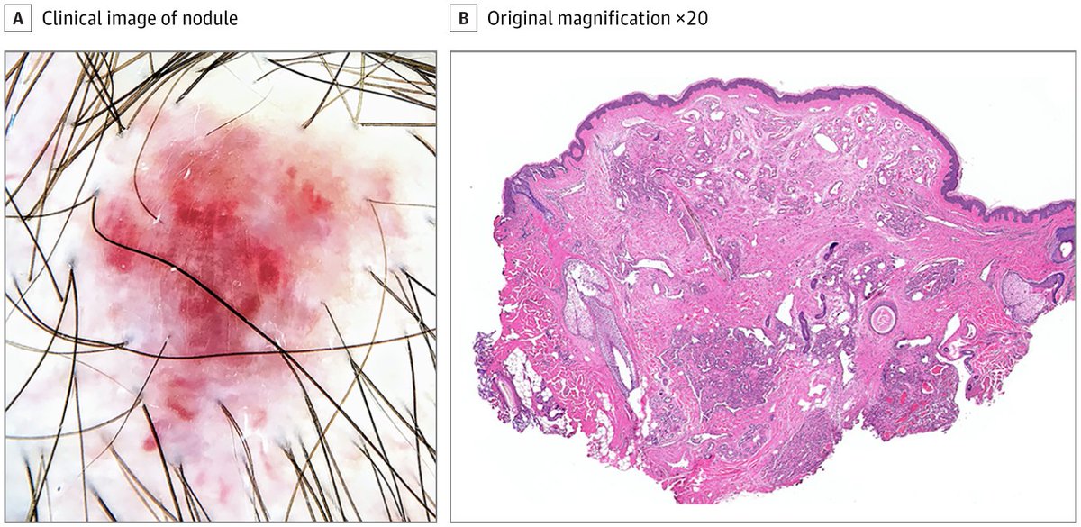 Take the JAMA Clinical Challenge An otherwise healthy man in his 40s was referred to the dermatology clinic for a slowly growing tumor on the scalp. Skin examination revealed an 8-mm red, firm, mobile nodule on the left temporal scalp.