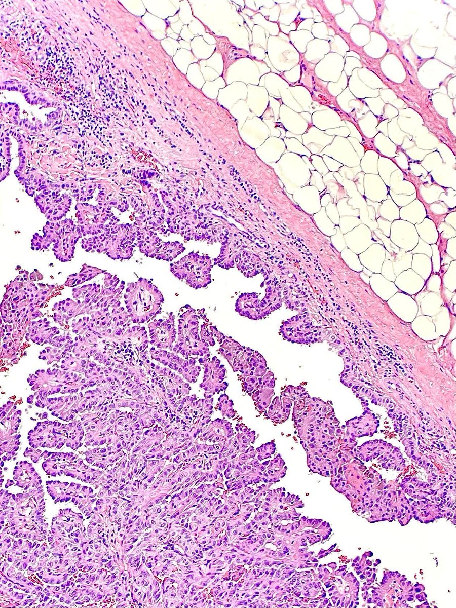 Resection of a neck mass revealing what type of tumor? Answer: buff.ly/49fae7m #PathArt #PathTwitter #MedTwitter
