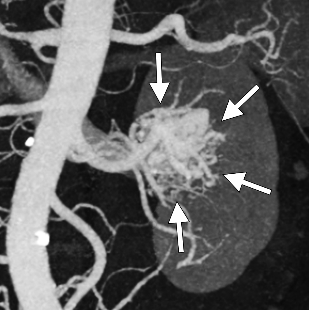 📢 Exciting findings in @JVIRmedia: Targeted transarterial embolization for renal arteriovenous malformations (rAVMs) could be a game changer based on patient-specific angioarchitecture! 🎯🩺 @SIRspecialists Lets dive into this insightful study 👇 🔍 18 patients with rAVMs, 25…
