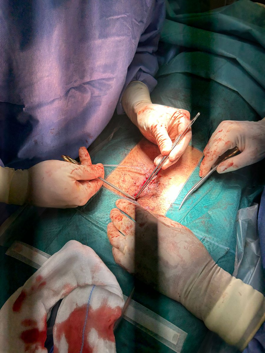Hoy cirugía compleja en paciente de 17a. con extrofia vesical, multioperado, con litiasis recidivante; 2ª enterocistoplastia de aumento y conducto cateterizable umbilical. Gracias a nuestra cirujana pediátrica de cabecera <a href="/rromeronline/">Rosa Romero</a> por llevarnos la mano. <a href="/UronefroHUVR/">@Uro-NefroHUVR</a>