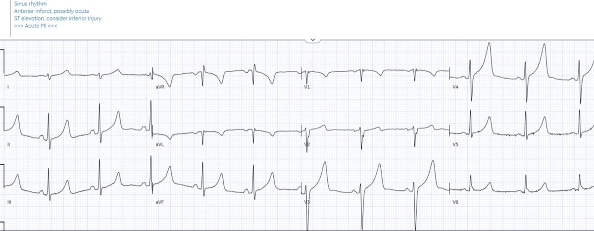 60 year old with shortness of breath and weakness. Is this STEMI? 
#ECG #EKG #FOAMed #MedEd #cardiology #Medstudent #paramedic #EmergencyMedicine