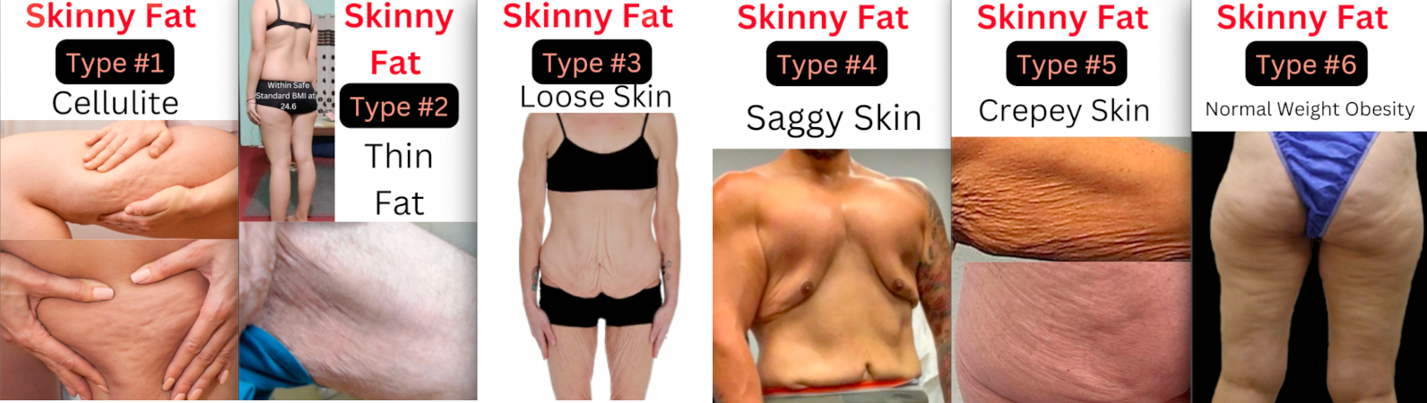 What is Skinny Fat - Scientific/Medical Definition of Skinny Fat