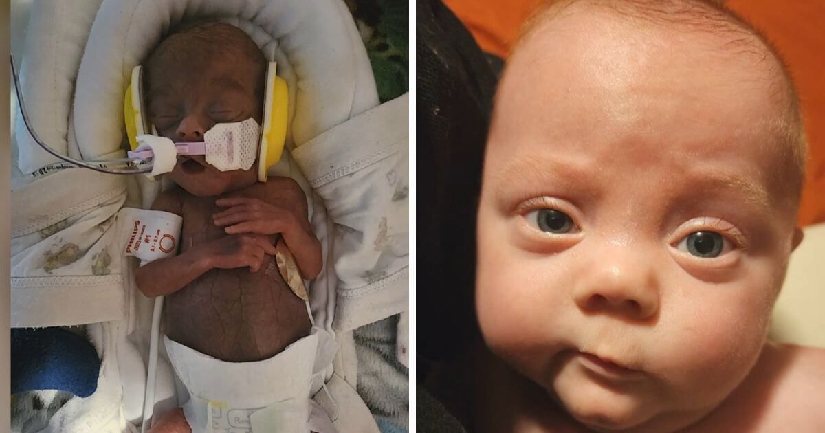 Miracle Baby Born Weighing Just 15 Ounces is Now 8 Months Old buff.ly/4aLiKeB