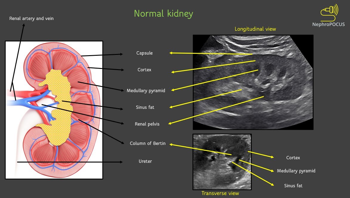 NephroP's tweet image. #POCUS