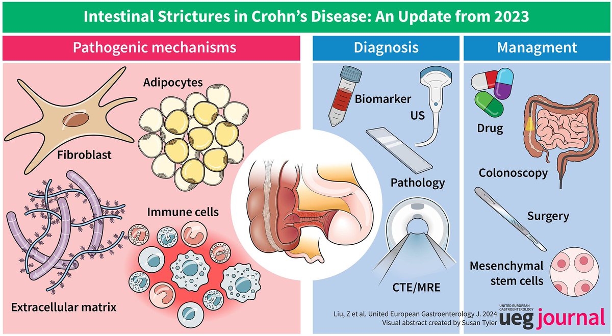 💥 Intestinal strictures in #Crohn's disease: ➡️ An update from 2️⃣0️⃣2️⃣3️⃣ ✅️ Pathogenic mechanism🦠⚡️🧬 ✅️ #Diagnosis 🩻 🩺🧪 ✅️ #Therapy 💊💉🔪 📕 only in @UEGJournal 🥰 👉 tinyurl.com/3c3r8j87 @my_ueg @WileyHealth @Y_ECCO_IBD @ESGE_news @SAGES_Updates #GITwitter