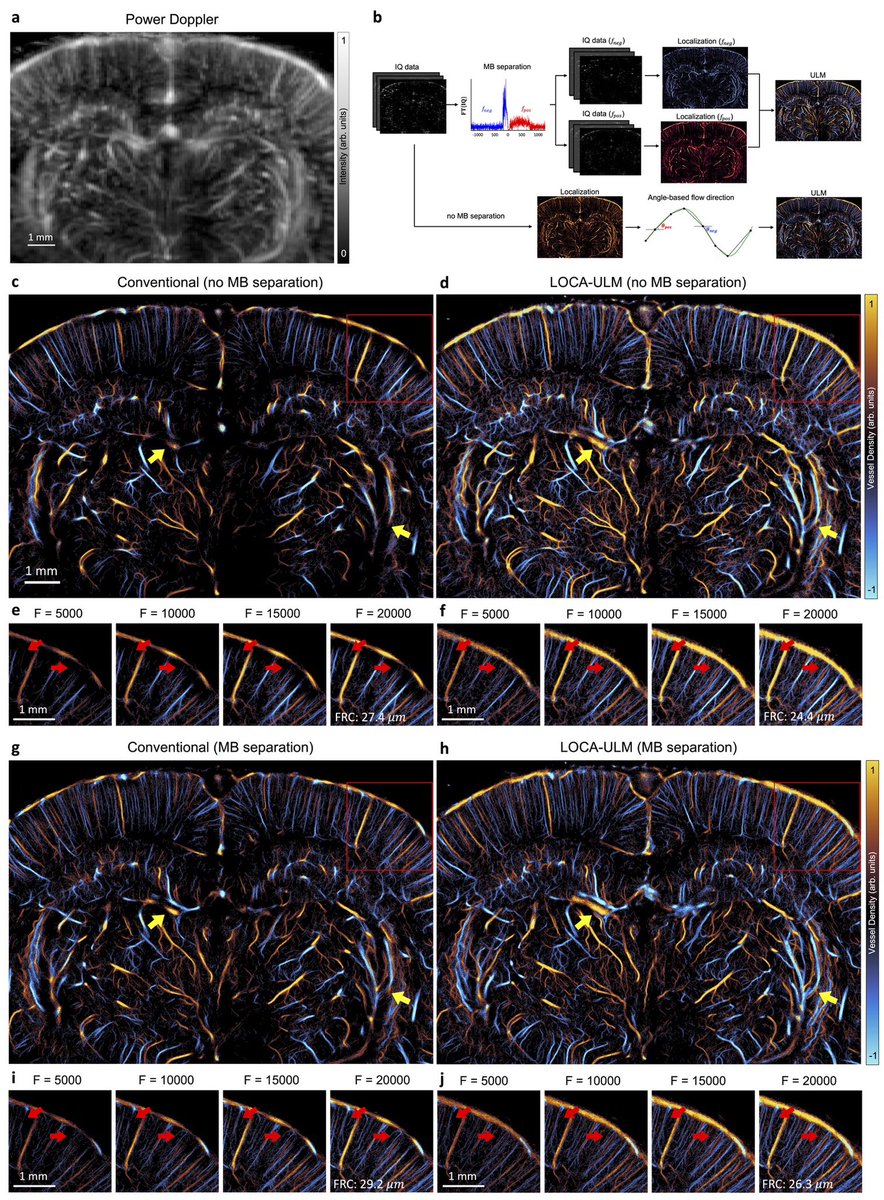 Excited to share that <a href="/yirangs2/">YiRangShin</a>'s work on LOCA-ULM has been published on <a href="/NatureComms/">Nature Communications</a>! When domain mismatch is addressed and context specific loss functions are used, DL indeed provides much better super-resolution ULM performance than existing methods. 

nature.com/articles/s4146…