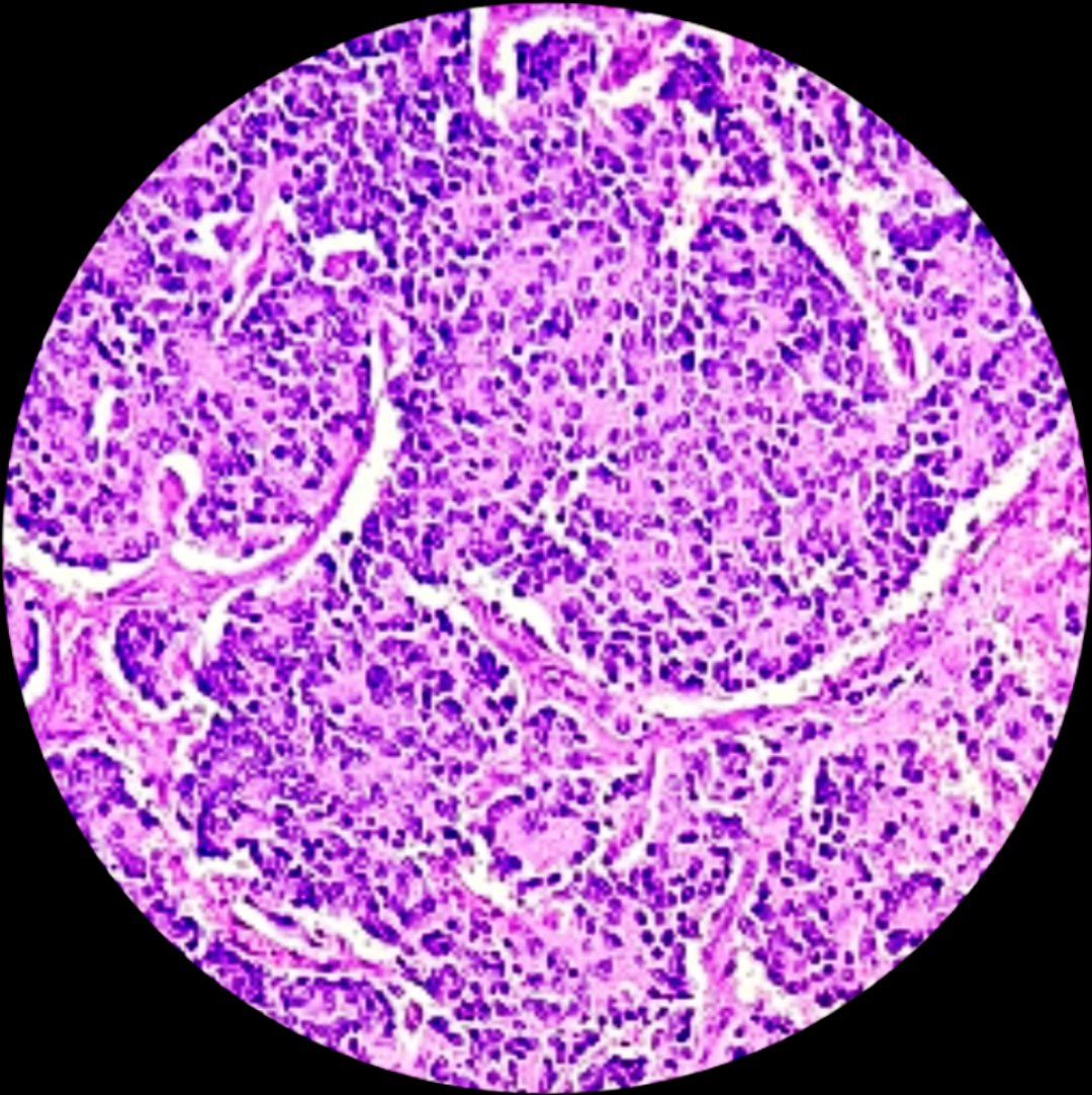 #Histopathology #retroperitoneum #growth 17-month-old boy. Retroperitoneal growth. # photomicrograph Dx: Neuroblastoma.