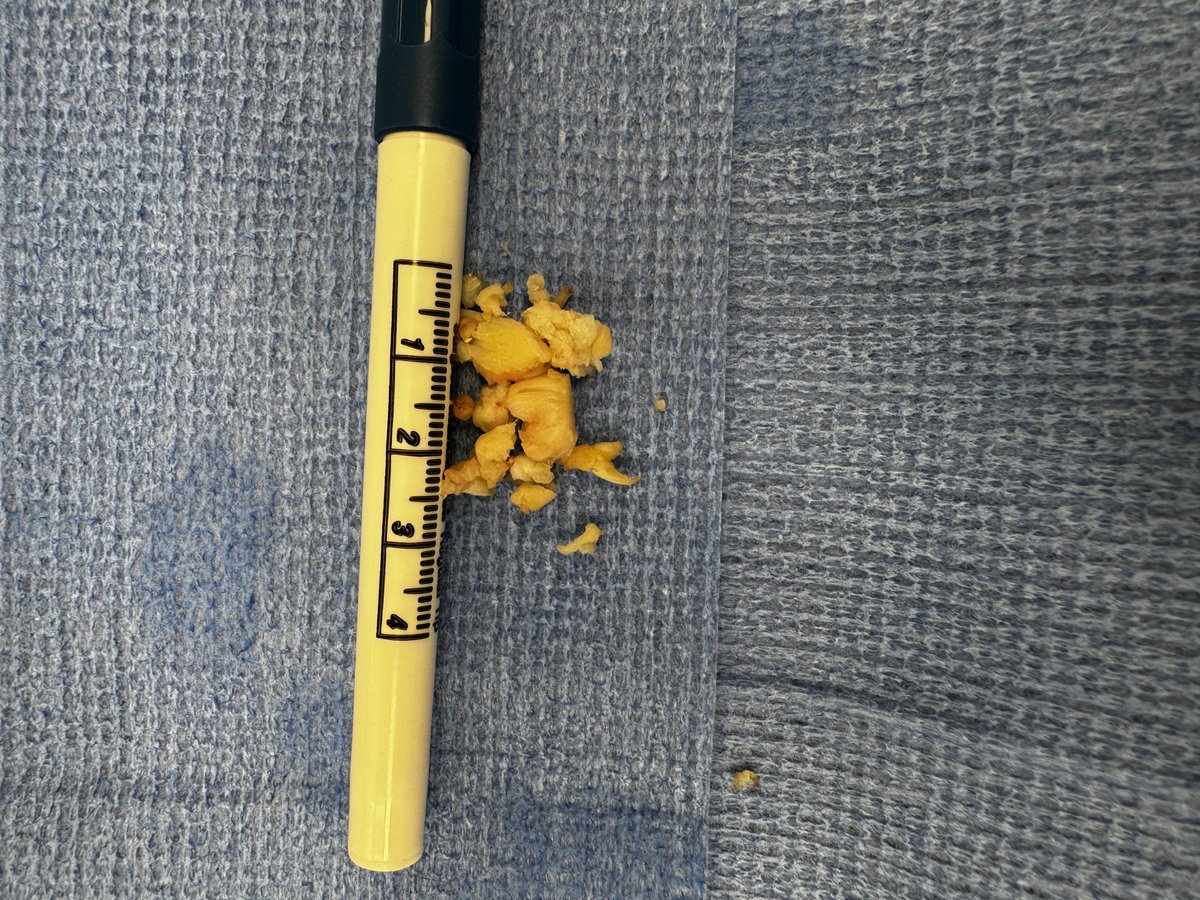 DrJonOh's tweet photo. @youngneuros
7 complex Endoscopic Spine cases over 2 OR days, 25 patients in 1 clinic day, a virtual webinar (#ISASS), ending the week with the #HoustonMethodist #EndoscopicSpineSurgery symposium. #WashUWay Can you keep up with @WashUNeurosurg #EndoscopicSpineSurgery Program? https://t.co/KK958rW8en