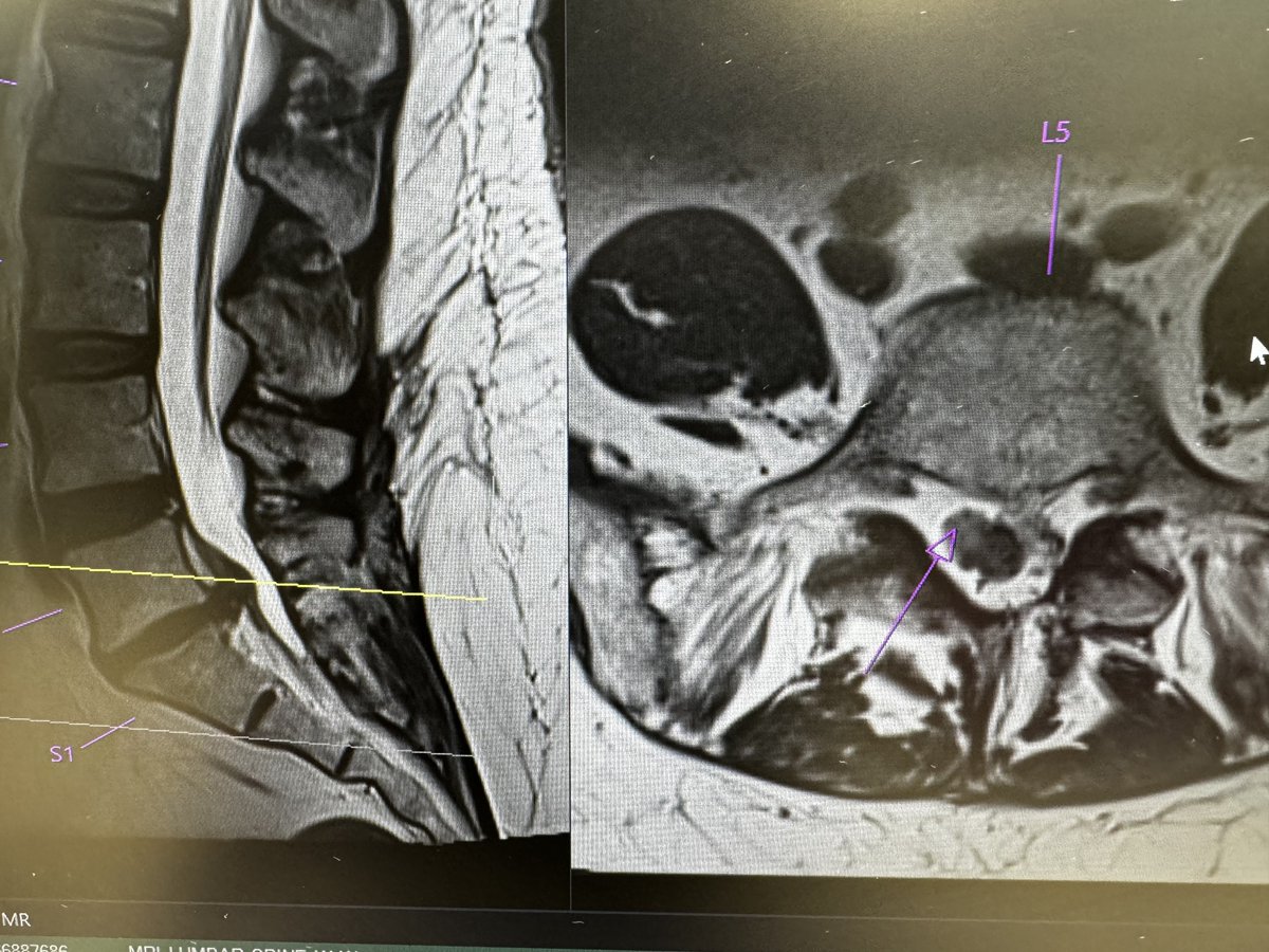 DrJonOh's tweet photo. @youngneuros
7 complex Endoscopic Spine cases over 2 OR days, 25 patients in 1 clinic day, a virtual webinar (#ISASS), ending the week with the #HoustonMethodist #EndoscopicSpineSurgery symposium. #WashUWay Can you keep up with @WashUNeurosurg #EndoscopicSpineSurgery Program? https://t.co/KK958rW8en
