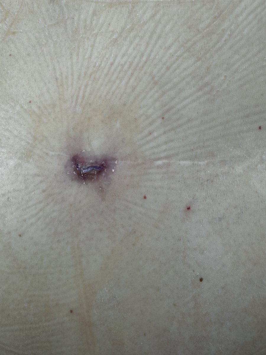 DrJonOh's tweet photo. @youngneuros
7 complex Endoscopic Spine cases over 2 OR days, 25 patients in 1 clinic day, a virtual webinar (#ISASS), ending the week with the #HoustonMethodist #EndoscopicSpineSurgery symposium. #WashUWay Can you keep up with @WashUNeurosurg #EndoscopicSpineSurgery Program? https://t.co/KK958rW8en
