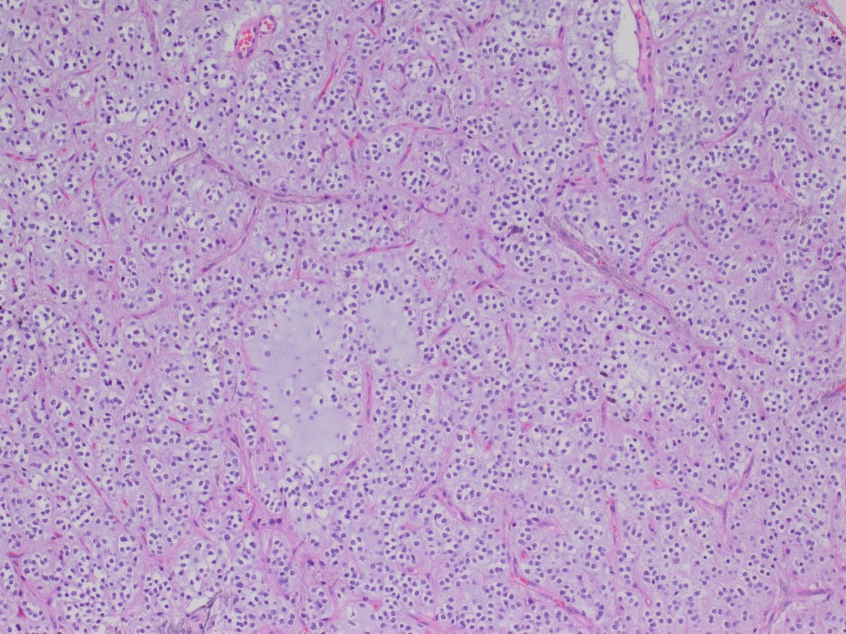 Approach to diagnosing glioneuronal tumors teaching was a hit this morning with the pathology residents & aspiring neuropathologists from the Flanagan lab! 🔬🧠😊

This oligo looking tumor was ultimately NOT an oligo nor a DGONC…..molecular keeps us humble 😉

#neuropathology