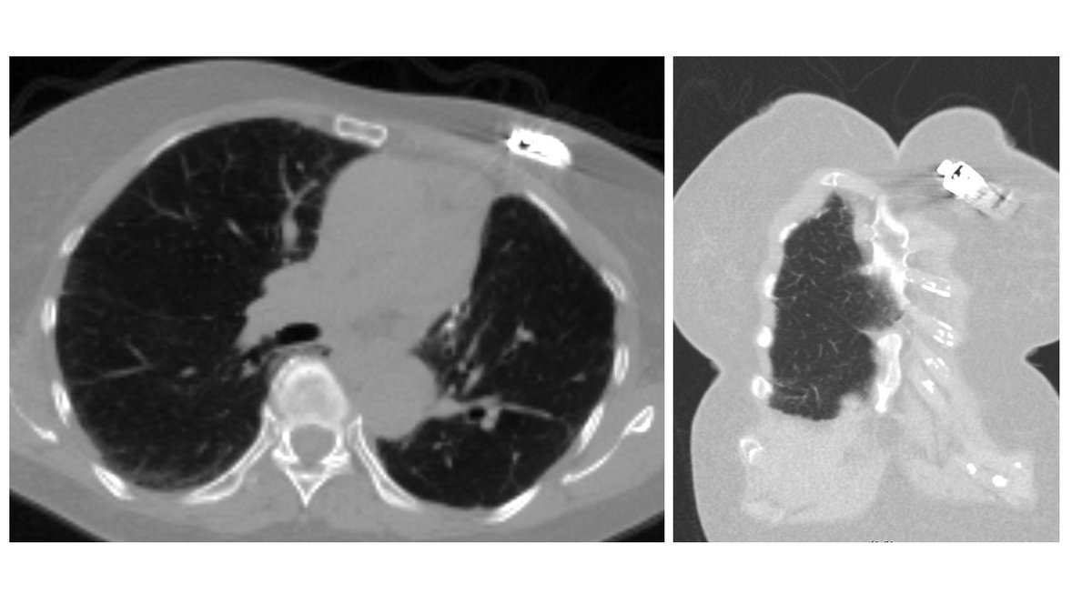 For #ThoracicThursday, new foreign body noted on a follow-up chest CT scan... what has happened in the interim?