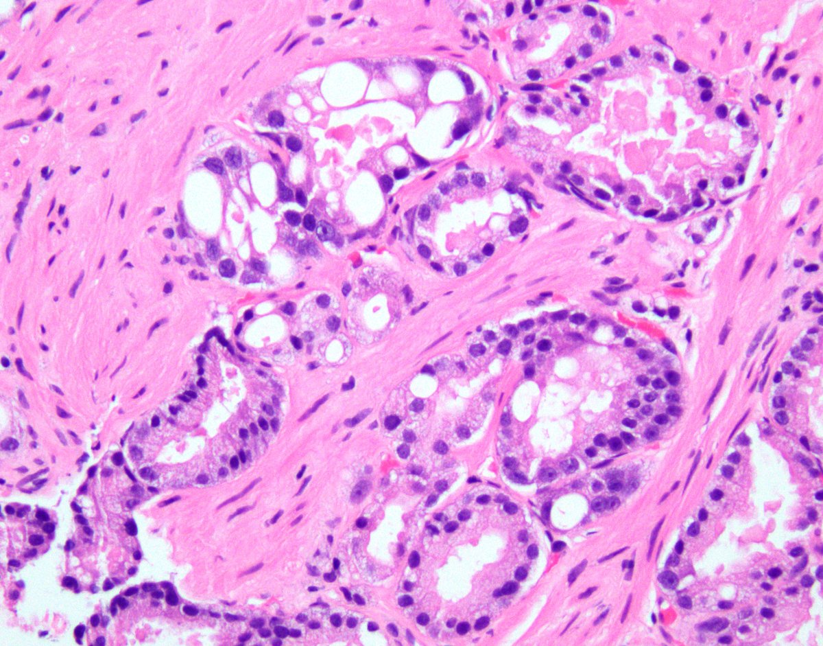 Vacuoles in #prostatecancer are most often seen in high grade patterns 4 & 5 - here an example of extreme vacuolization in otherwise discrete glands (pattern 3 IMO) - a finding that should NOT lead to upgrading #gupath #pitfalls