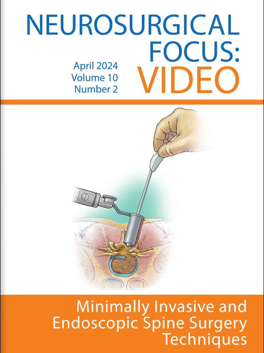 UCSF Neurosurgery (@neurosurgucsf) on Twitter photo On the cover of Neurosurgical Focus: Video, <a href="/UCSFMedicine/">UCSF School of Medicine</a> student Michael Tawil, <a href="/UCSFHospitals/">UCSF Health</a> neurosurgeon Lee Tan, MD & colleagues demonstrate for the first time how minimally invasive ultrasound could be used during tubular microdiscectomy: thejns.org/video/view/jou… On the cover of Neurosurgical Focus: Video, <a href="/UCSFMedicine/">UCSF School of Medicine</a> student Michael Tawil, <a href="/UCSFHospitals/">UCSF Health</a> neurosurgeon Lee Tan, MD & colleagues demonstrate for the first time how minimally invasive ultrasound could be used during tubular microdiscectomy: thejns.org/video/view/jou…