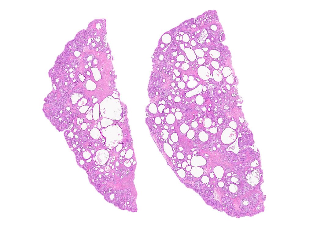 It was great to see many of you at #USCAP2024 ! Hope the meeting won't be eclipsed 🌕🌑by this great case, again brought to you by @MeladDababnehMD @ENT_Path headandneckpathology.com/head-neck-case…