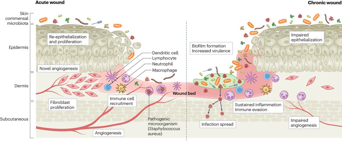The wound microbiota: microbial mechanisms of impaired wound healing and infection rdcu.be/dDI0s Grice & co explore the diversity of microbes present in wounds and examine the mechanisms through which they invade skin tissues, impair skin repair and cause infection.
