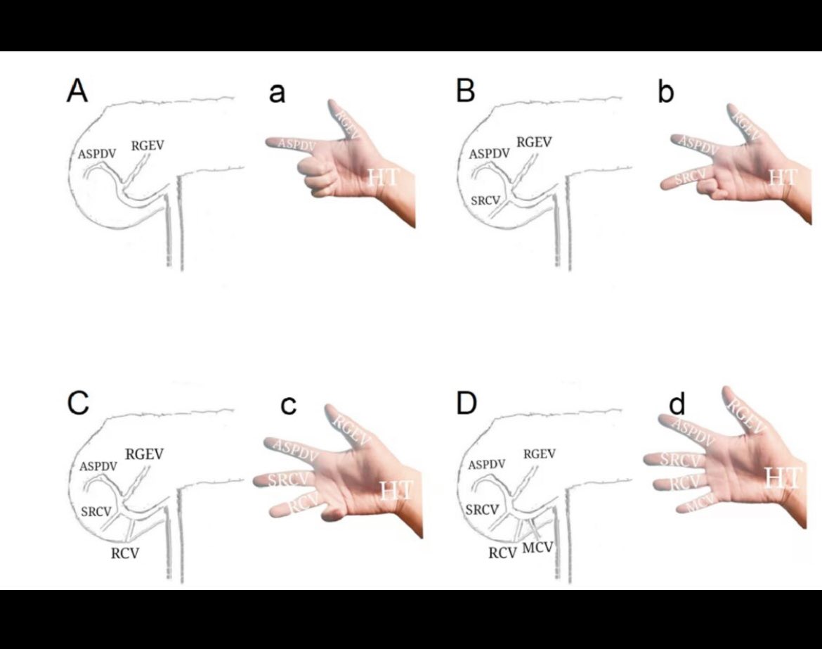 SIPAD_Italia's tweet photo. TRONCO VENOSO GASTROCOLICO DI HENLE, LO CONOSCI?
https://t.co/VQunVsZ1bG
https://t.co/nEjSmdKdZL
#SoMe4Surgery #anatomy #GastricCancer #CME #pancreaticcancer https://t.co/gakNxiGOR8